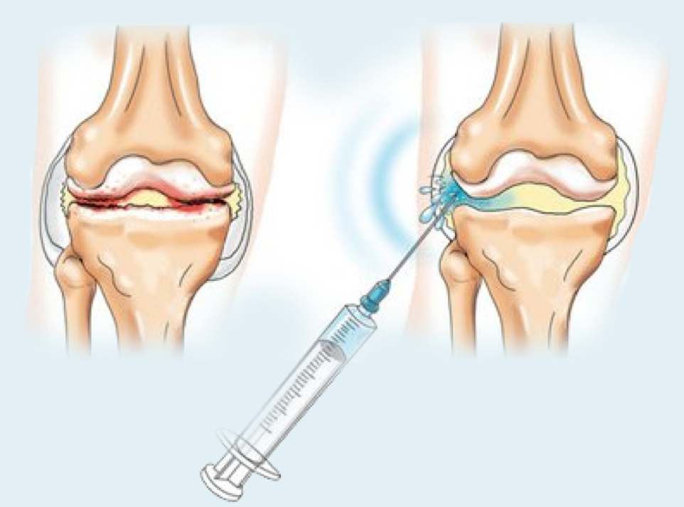 Инъекции ГК в сустав.png Инъекции ГК в сустав.png